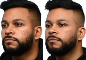 Morpheus8 Before & After Gallery - Patient 109010 - Image 3