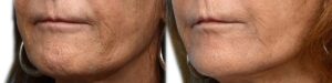 Morpheus8 Before & After Gallery - Patient 262067 - Image 2