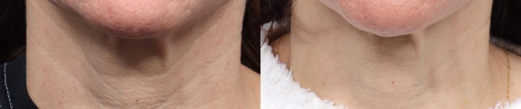 Morpheus8 Before & After Gallery - Patient 410976 - Image 1