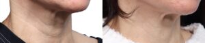 Morpheus8 Before & After Gallery - Patient 410976 - Image 2