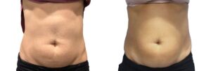 Morpheus8 Before & After Gallery - Patient 413975