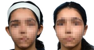 Otoplasty Before & After Gallery - Patient 138735
