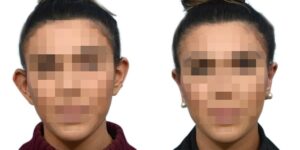 Otoplasty Before & After Gallery - Patient 272676