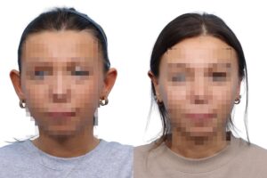 Otoplasty Before & After Gallery - Patient 357160
