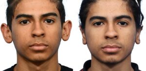 Otoplasty Before & After Gallery - Patient 373165