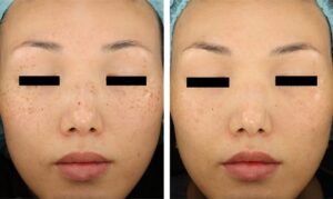 PicoWay Before & After Gallery - Patient 101005
