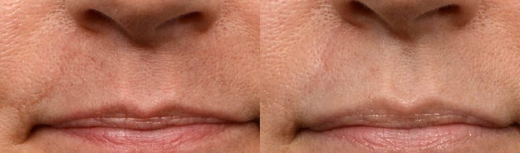 PicoWay Before & After Gallery - Patient 101472 - Image 1