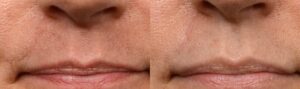 PicoWay Before & After Gallery - Patient 101472