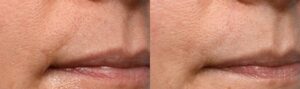 PicoWay Before & After Gallery - Patient 101472 - Image 2