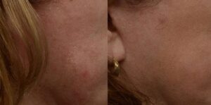 PicoWay Before & After Gallery - Patient 366282