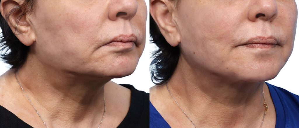 QuantumRF Before & After Gallery - Patient 417241 - Image 1