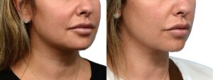 Ultherapy Before & After Gallery - Patient 227773