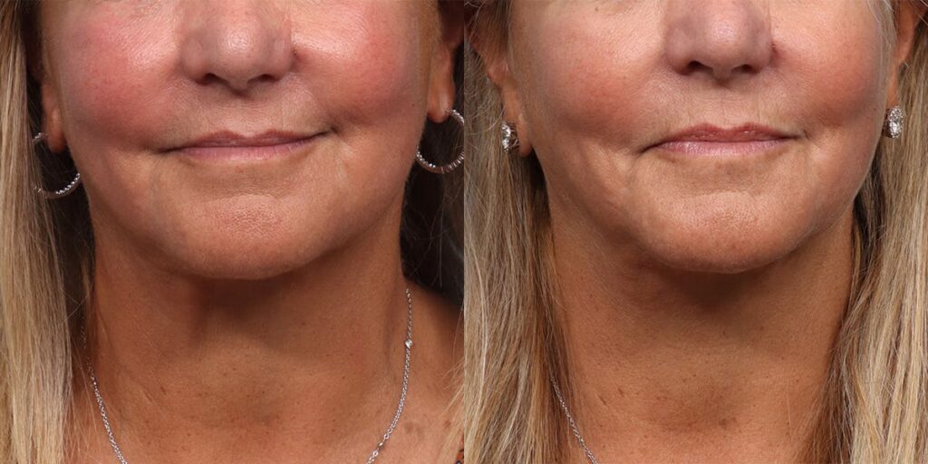 Ultherapy Before & After Gallery - Patient 355705 - Image 1