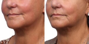 Ultherapy Before & After Gallery - Patient 355705 - Image 2