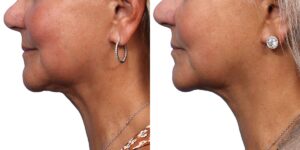 Ultherapy Before & After Gallery - Patient 355705 - Image 3