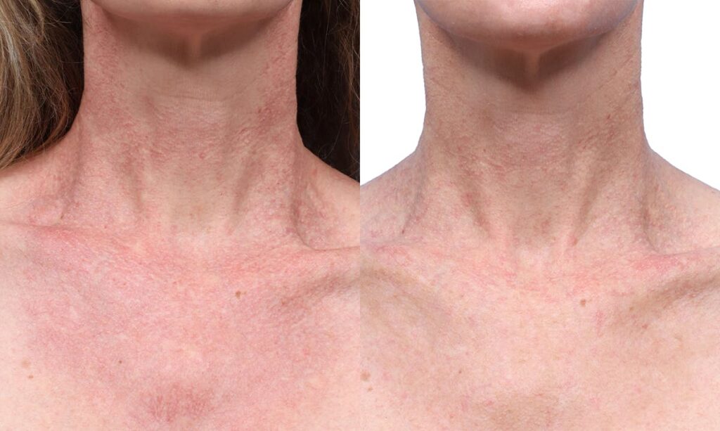VBeam Before & After Gallery - Patient 367635 - Image 1