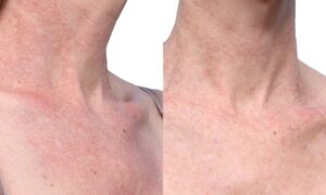 VBeam Before & After Gallery - Patient 367635 - Image 2