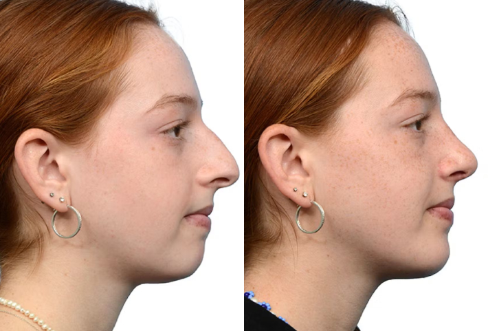 Rhinoplasty
